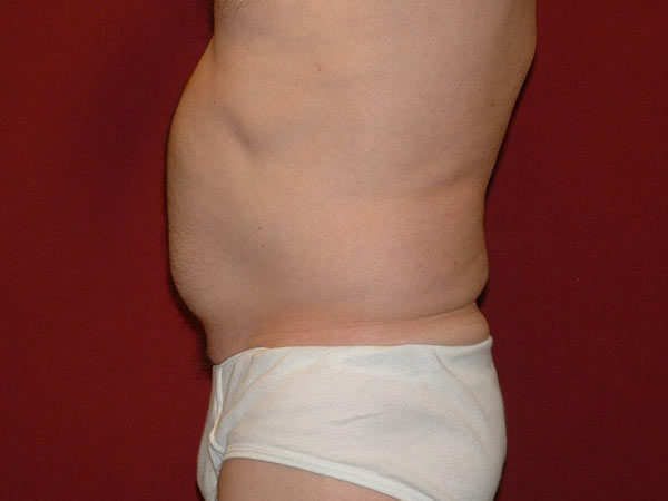 Liposuction Patient 04 Before 2