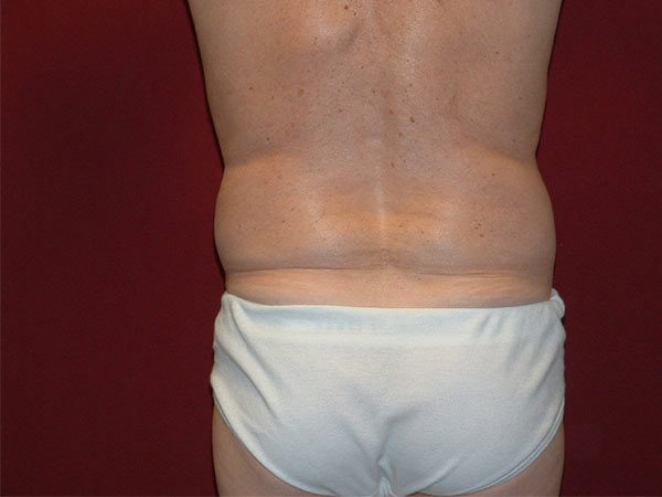 Liposuction Patient 04 Before 1