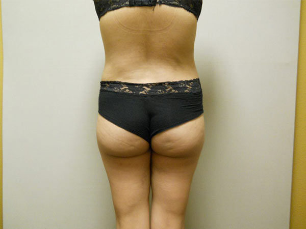 Liposuction Patient 06 After 2