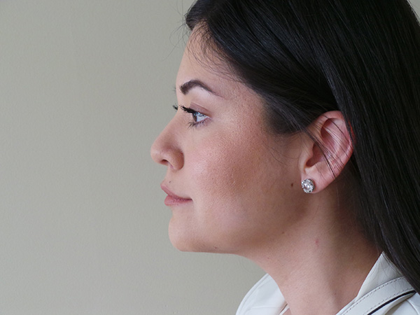 Liposuction Patient 09 After 1