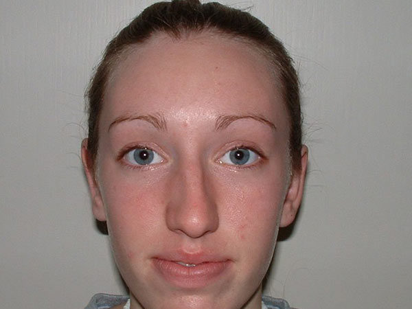 Otoplasty Patient 02 After 1