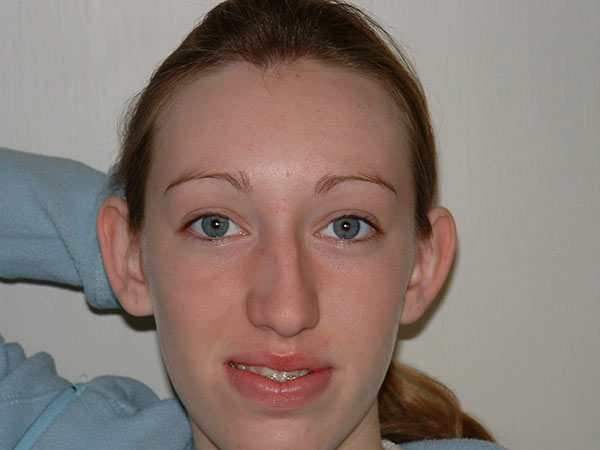 Otoplasty Patient 02 Before 1