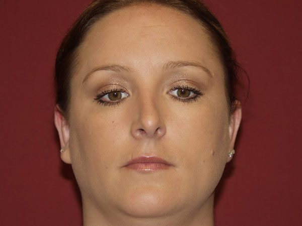 Otoplasty Patient 03 After 1