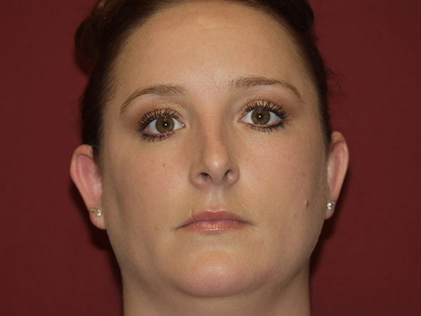 Otoplasty Patient 03 Before 1