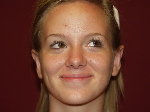 Otoplasty Patient 04 After 1