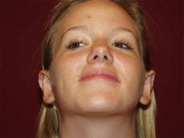 Otoplasty Patient 04 After 2