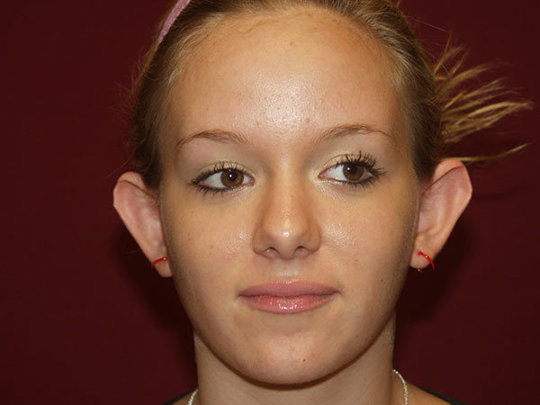 Otoplasty Patient 04 Before 1