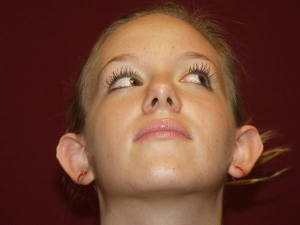 Otoplasty Patient 04 Before 2