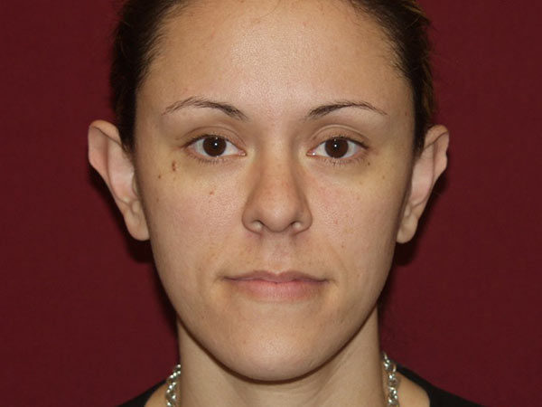 Otoplasty Patient 05 Before 1