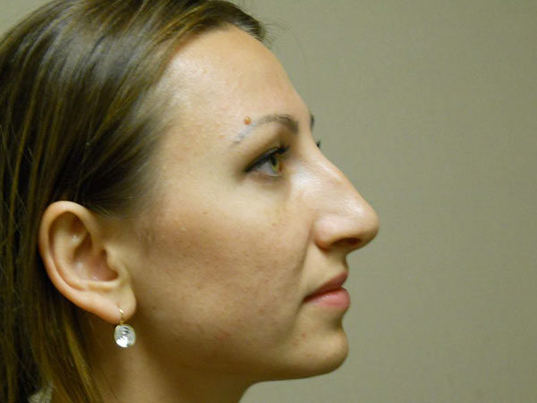 Rhinoplasty Patient 01 Before 2