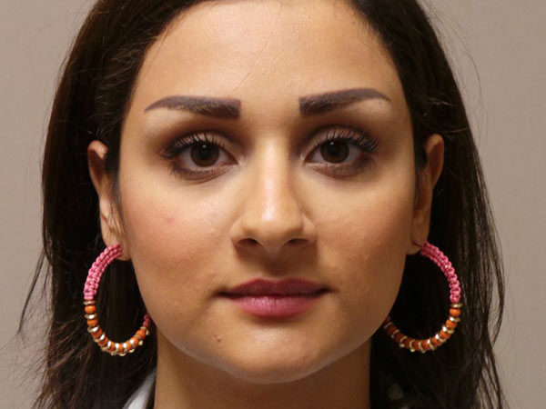 Rhinoplasty Patient 29 Before 1