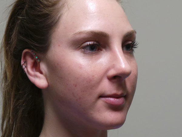 Rhinoplasty Patient 27 After 2