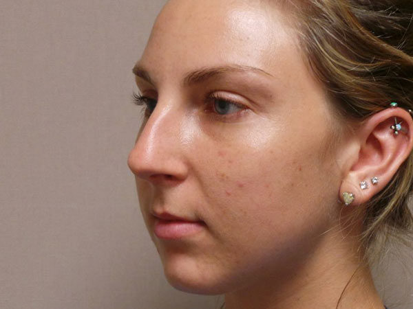 Rhinoplasty Patient 27 Before 1