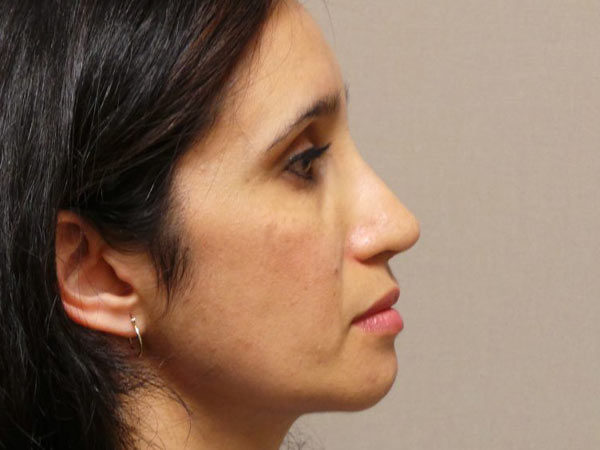 Rhinoplasty Patient 13 After 1
