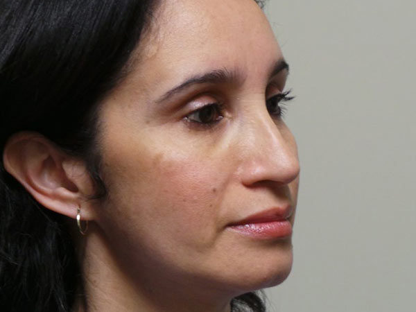 Rhinoplasty Patient 13 After 2