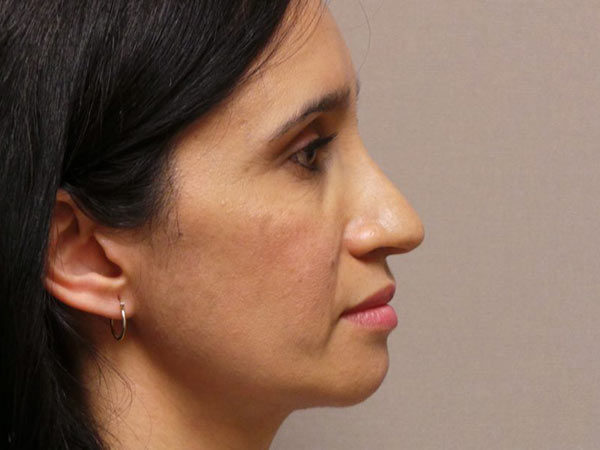 Rhinoplasty Patient 13 Before 1
