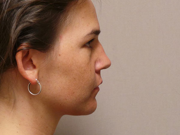 Rhinoplasty Patient 28 Before 1
