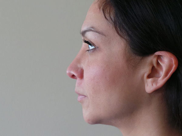 Rhinoplasty Patient 25 After 1