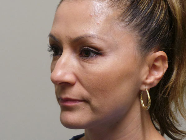 Rhinoplasty Patient 26 Before 2