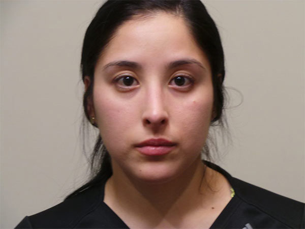 Rhinoplasty Patient 20 After 2