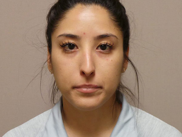 Rhinoplasty Patient 20 Before 2