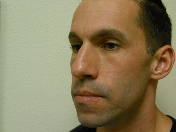 Rhinoplasty Patient 02 Before 2