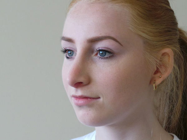 Rhinoplasty Patient 16 After 2