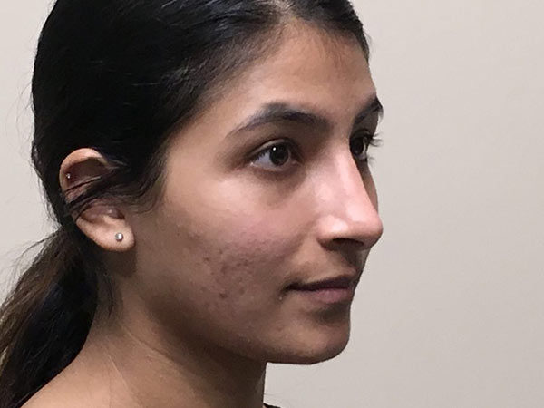 Rhinoplasty Patient 17 After 2