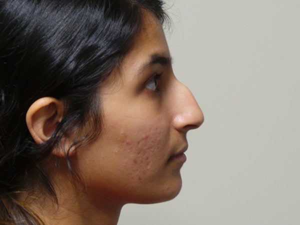 Rhinoplasty Patient 17 Before 1