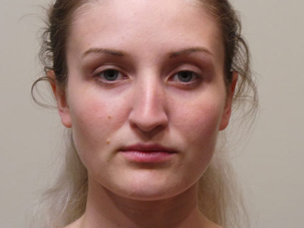 Rhinoplasty Patient 18 Before 2