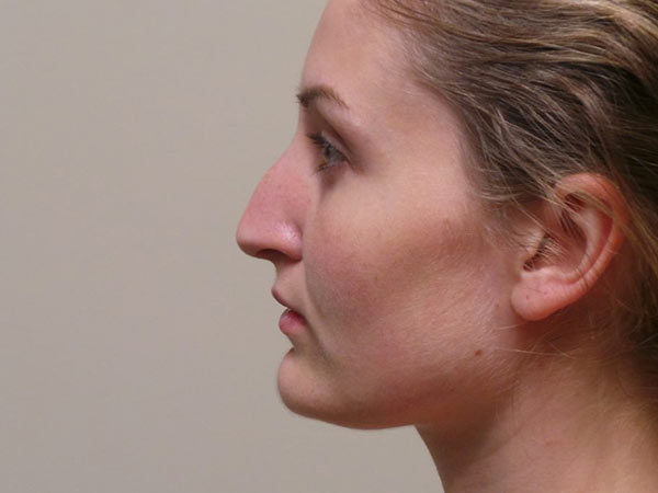 Rhinoplasty Patient 18 Before 1