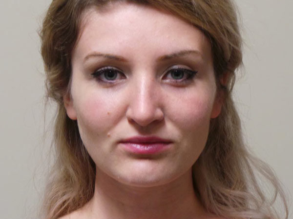 Rhinoplasty Patient 18 After 2