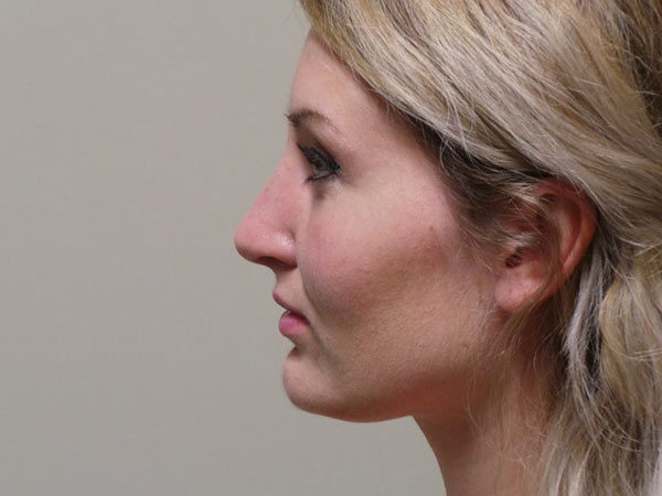 Rhinoplasty Patient 18 After 1