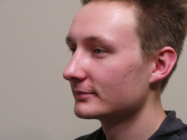 Rhinoplasty Patient 14 After 1