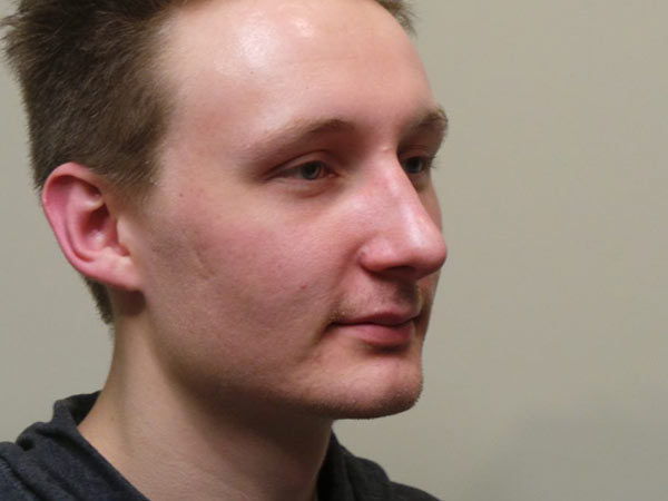 Rhinoplasty Patient 14 After 2