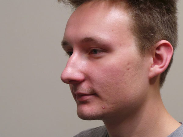 Rhinoplasty Patient 14 Before 1