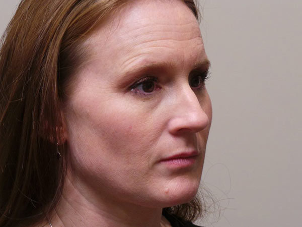 Rhinoplasty Patient 11 Before 2