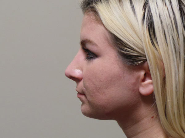 Rhinoplasty Patient 12 After 1