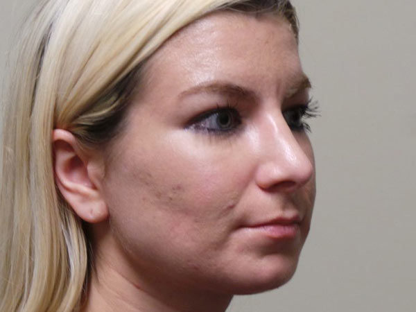 Rhinoplasty Patient 12 After 2