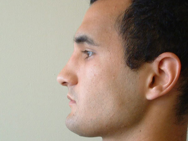 Rhinoplasty Patient 03 After 1