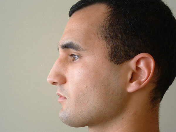 Rhinoplasty Patient 03 Before 1