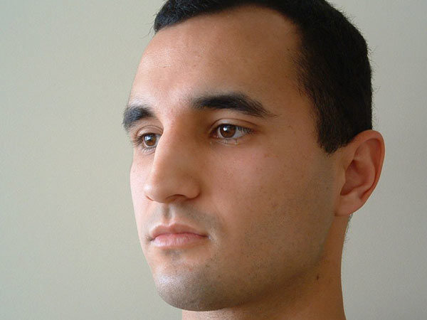 Rhinoplasty Patient 03 Before 2