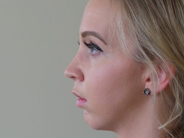 Rhinoplasty Patient 08 After 1