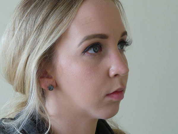 Rhinoplasty Patient 08 After 2