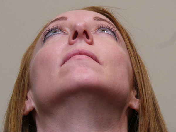 Rhinoplasty Patient 06 Before 2