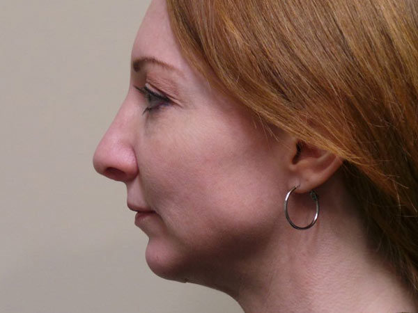 Rhinoplasty Patient 06 After 1
