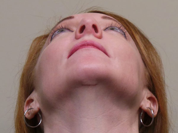 Rhinoplasty Patient 06 After 2