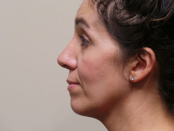 Rhinoplasty Patient 05 After 2