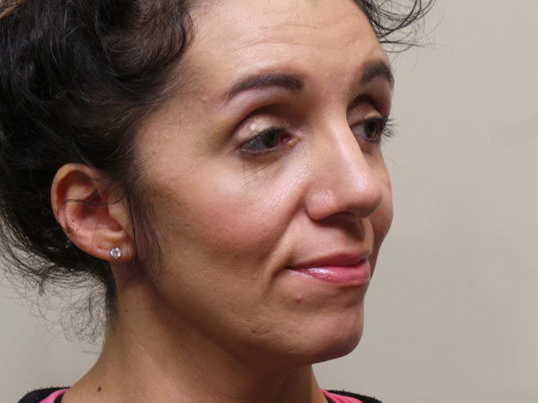 Rhinoplasty Patient 05 After 1