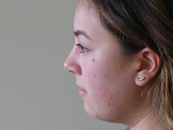 Rhinoplasty Patient 33 After 1